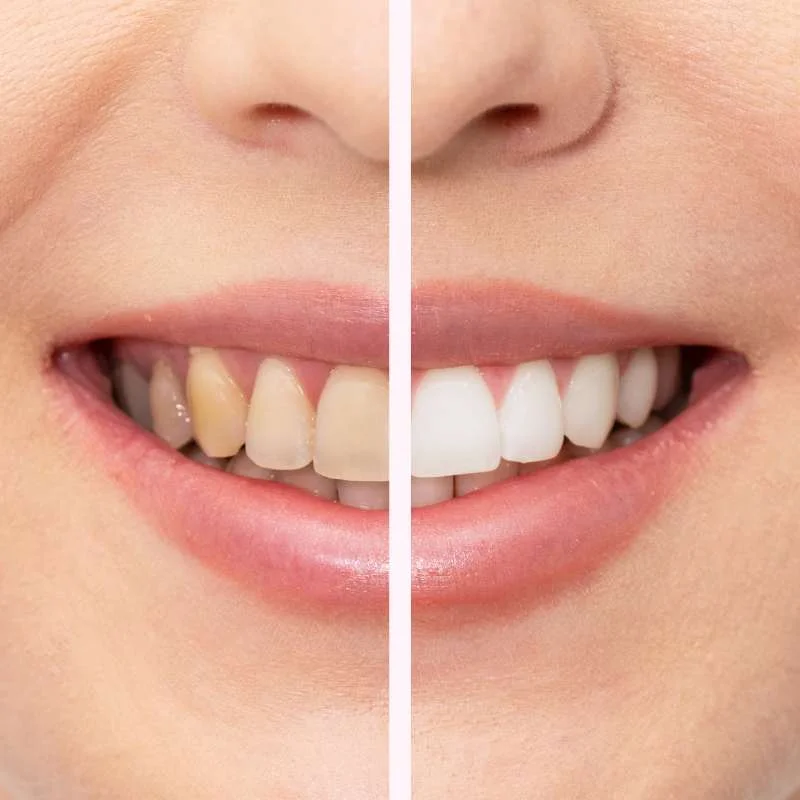Teeth Whitening Course and Certificate Near Me Hamilton Ajiel MD